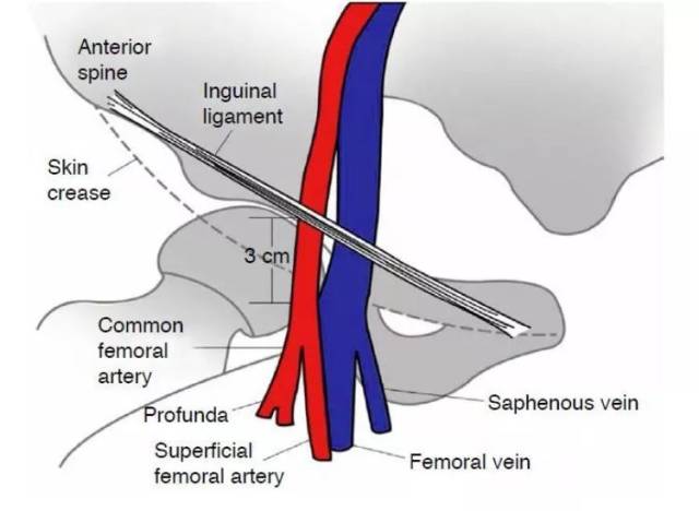 腹股沟动脉穿刺部位图片