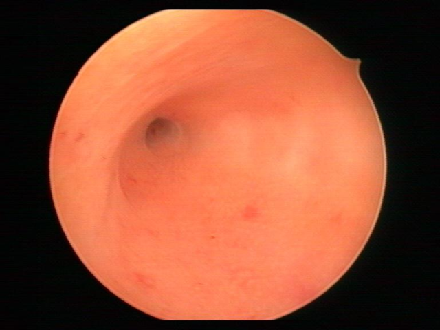 宫腔镜检查知多少