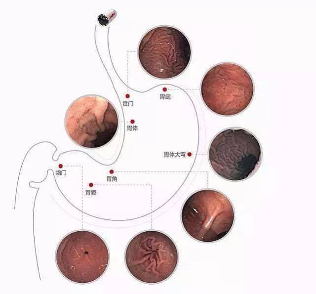 胃镜检查全过程示意图图片