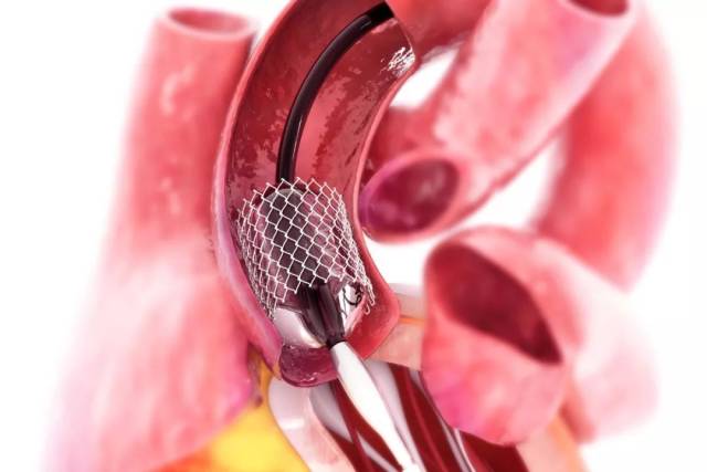 介入医生的噩梦——支架内血栓,你了解多少?丨pci专场