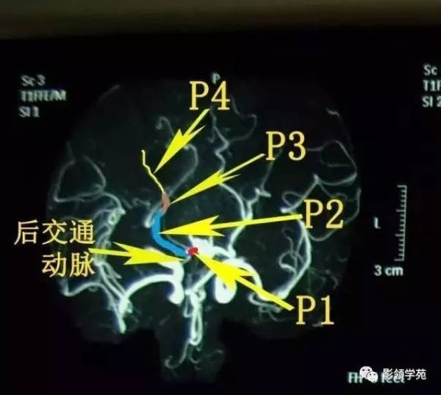 头颅MRA解剖图片