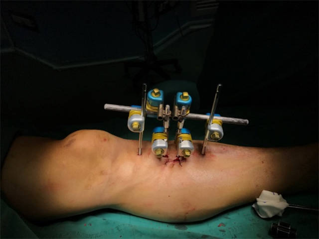 广西运用"胫骨横向骨搬移技术"取得突破性进展