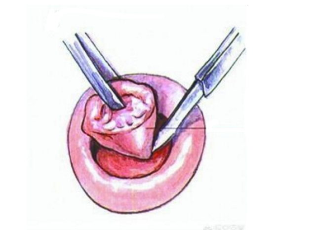 宫颈锥切术图解图片