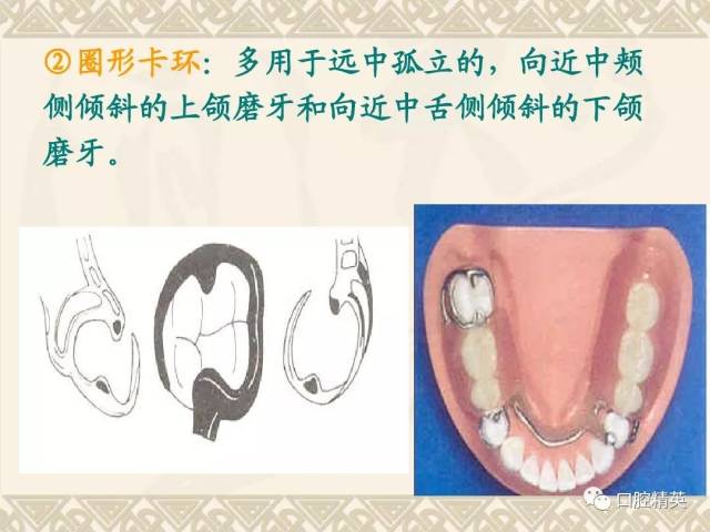 局部義齒-卡環