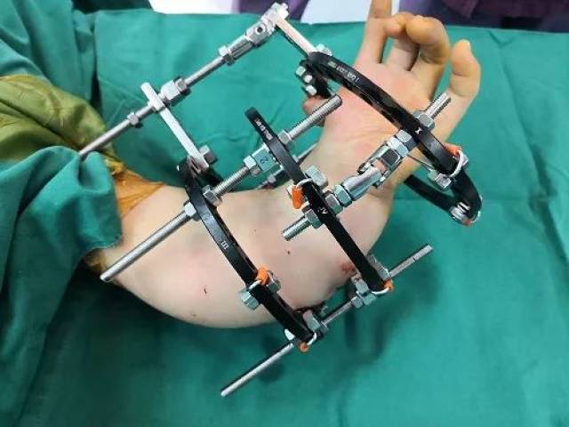 佛山禅城中心医院,李旭儿童骨科团队完成该院第一台严重先天上肢畸形