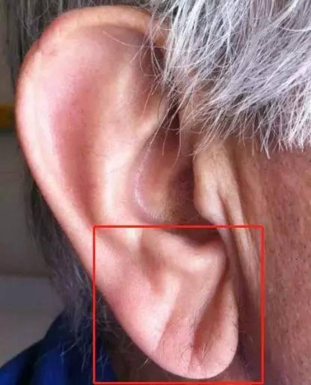 耳垂上有条皱纹是怎么回事看完答案要重视起来
