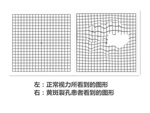 难治性黄斑裂孔患者只能等待失明吗林顺潮教授在世界性眼科大会上分享