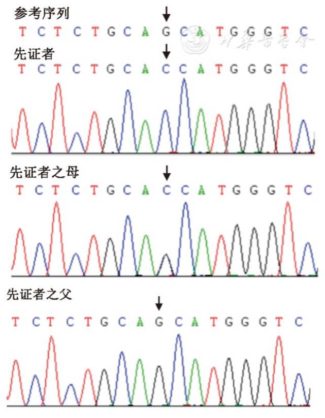 【神经系统疾病研究】slc16a2基因突变致allan-herndon-dudley综合征