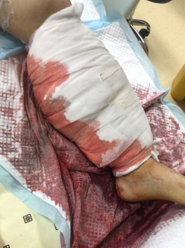 出车祸腿受伤的照片图片