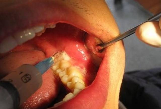 大牙不能治疗了,拔大牙有什么危害和注意事项?
