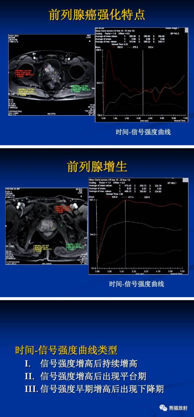 磁共振前列腺图像解析图片