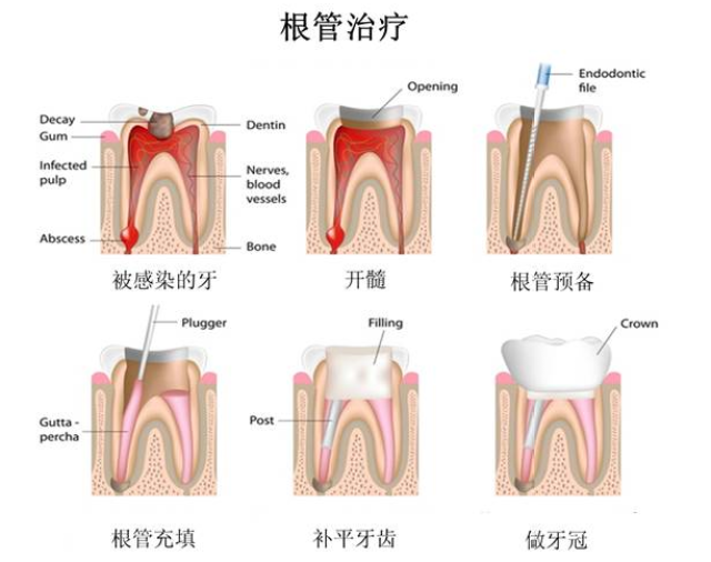 一般来说,根管治疗需要就诊2-4次,用时2-3周.