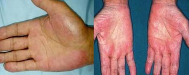 肝掌指患慢性肝炎特别是肝硬变后,双手手掌两侧的大,小鱼际和指尖掌面