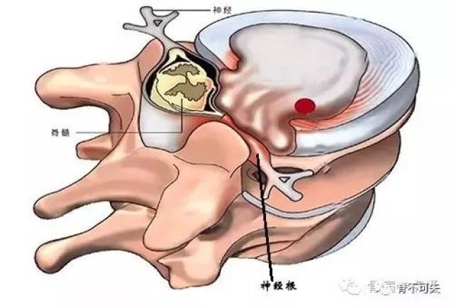 颈椎微创手术之后路椎间孔镜 (原创)