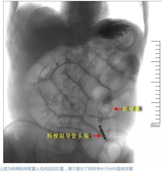 腸梗阻導管的臨床應用