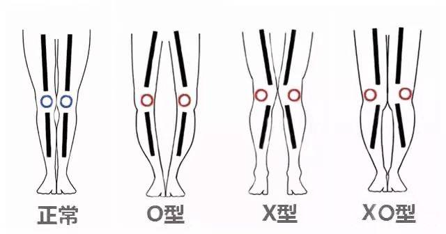 这招真厉害,多年的XO腿型矫正过来了!