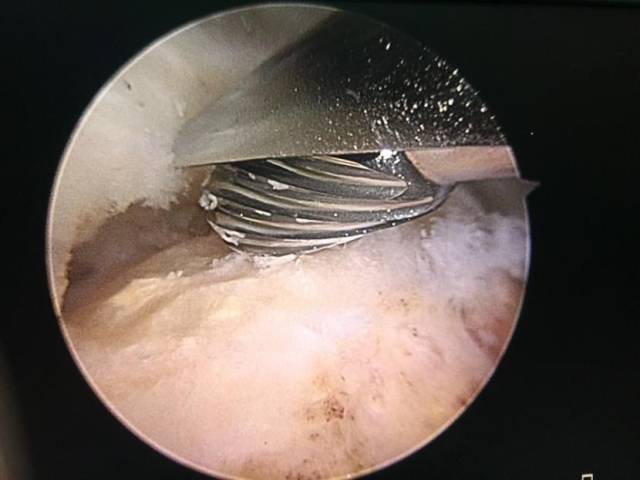 肩关节疼痛以为是肩周炎?错,其实是肩袖损伤!