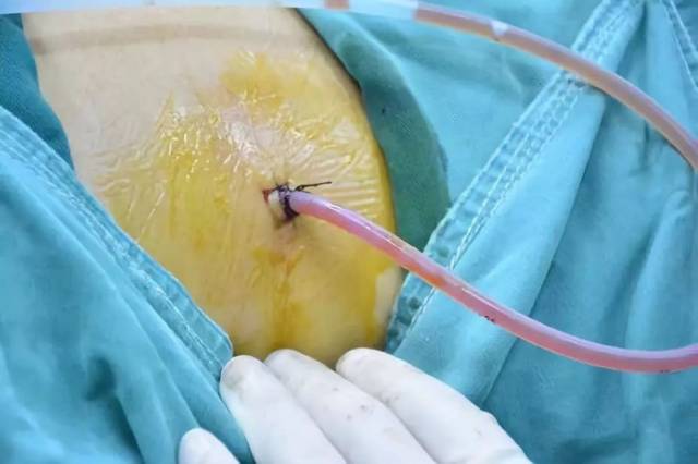 胆囊微创手术打孔图片图片