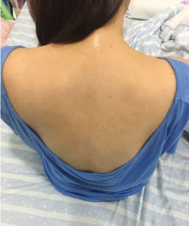 28岁女人全身黄褐斑,3个方法调节内分泌,黄褐斑不攻自破