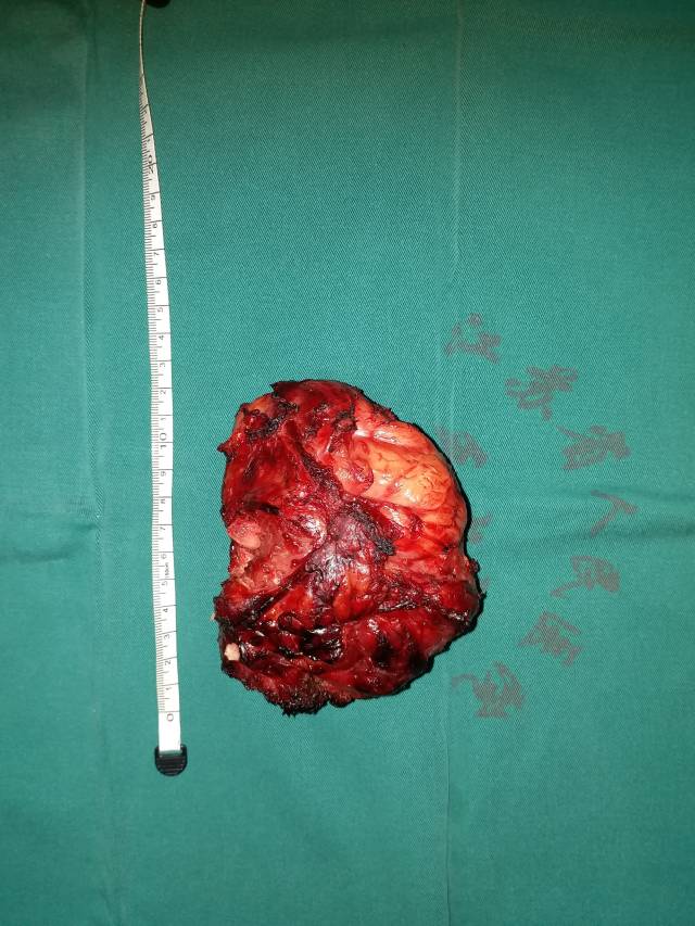 一例巨大颈肩部恶性肿瘤在江苏省人民医院骨与软组织肿瘤科 (原创)