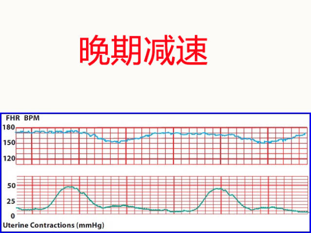 胎心监护报告图解析:胎儿监护中各类型减速的特点