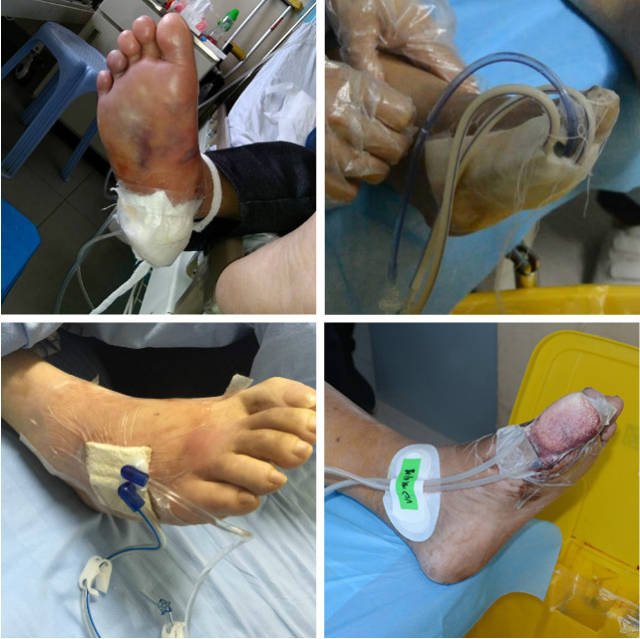 糖尿病足的治疗与负压引流