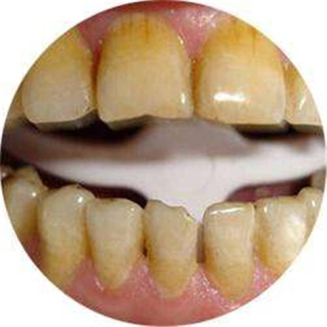 牙齿发黄是什么原因?牙黄真么办?
