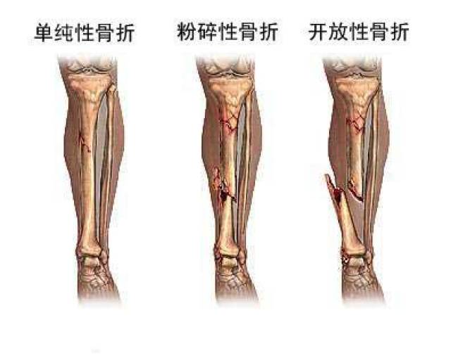 骨科医生:孩子“青枝骨折”后,作为家长应该这样做!_搜狐网