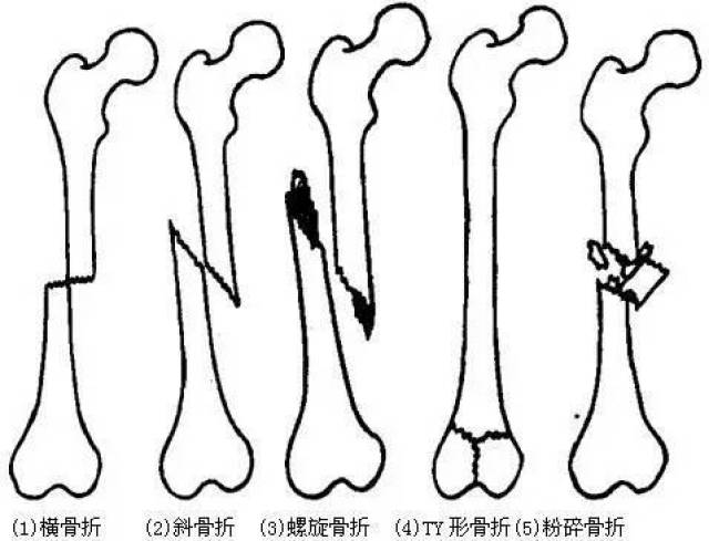 青枝骨折 名词解释图片