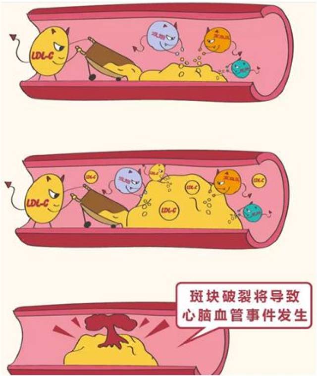 动脉粥样硬化心血管疾病与他汀兄弟的那些事