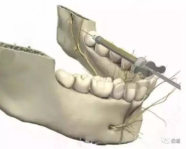 下牙槽动脉图片