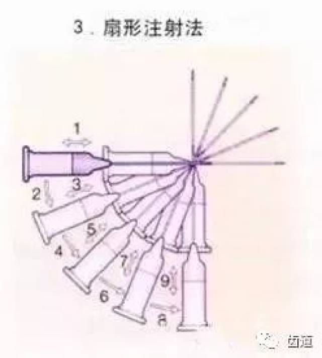 牙周膜麻醉注射方法图片