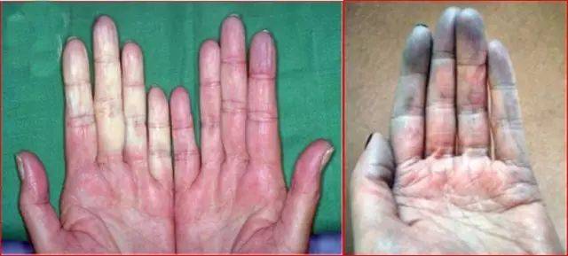 天鹅颈手指畸形