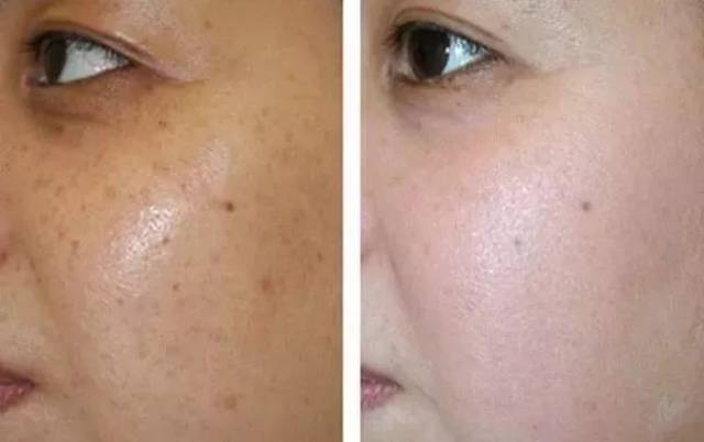 法国变态"线雕童颜术"!