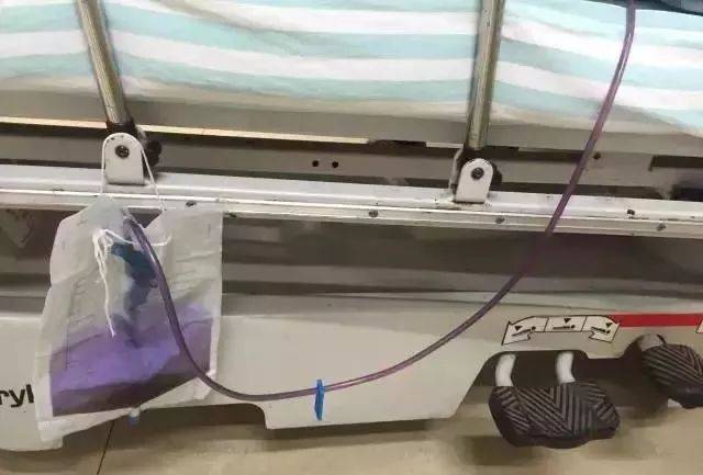 留置导尿 2 个月,尿液竟突然变成紫色,这个案例护士一定得知道!