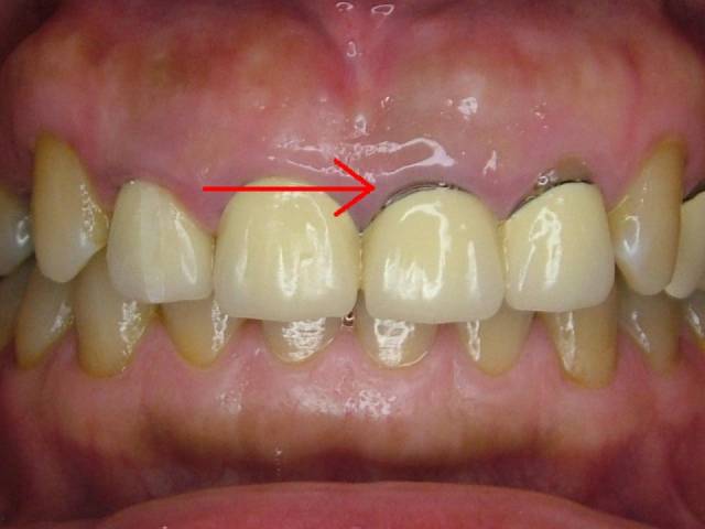 烤瓷牙的使用寿命到底多久?_手机搜狐网