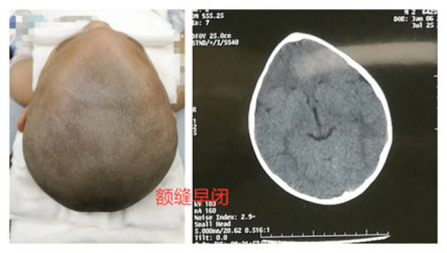 三角头畸形 冠状缝图片