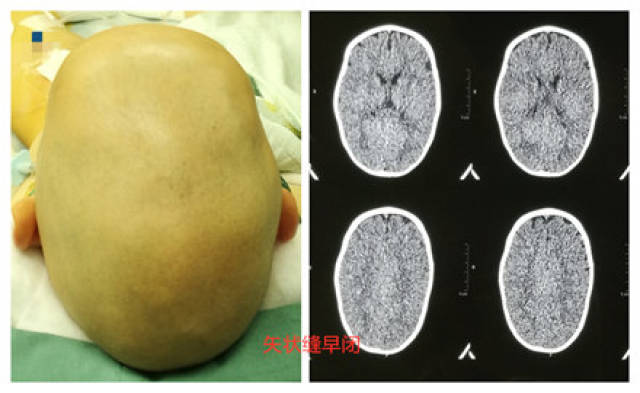 前脑无裂畸形图片