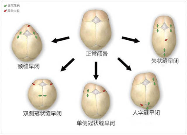 1, 额缝早闭典型的表现为三角头畸形,前额正中锋利的龙骨样突起,并有