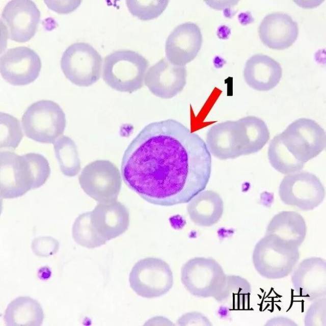 图2:原始细胞(aml患者,考虑原始粒细胞,胞浆中含一短小auer小体,骨髓
