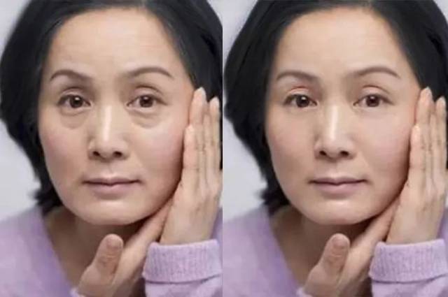 最头痛的眼周问题, 不是眼角细纹,也不是眼皮松弛, 是 眼袋!