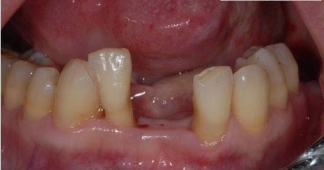 倒数第二颗的大牙坏了,用不用镶一颗呢?_手机搜狐网