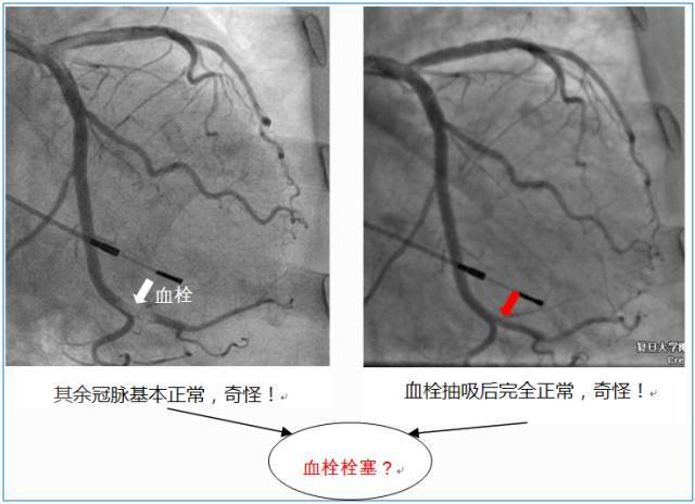 不一样的急性心肌梗死冠脉血栓栓塞的诊断思路