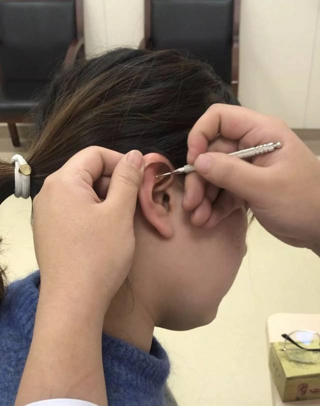 扎扎耳朵就能减肥和治失眠?中医耳针了解下