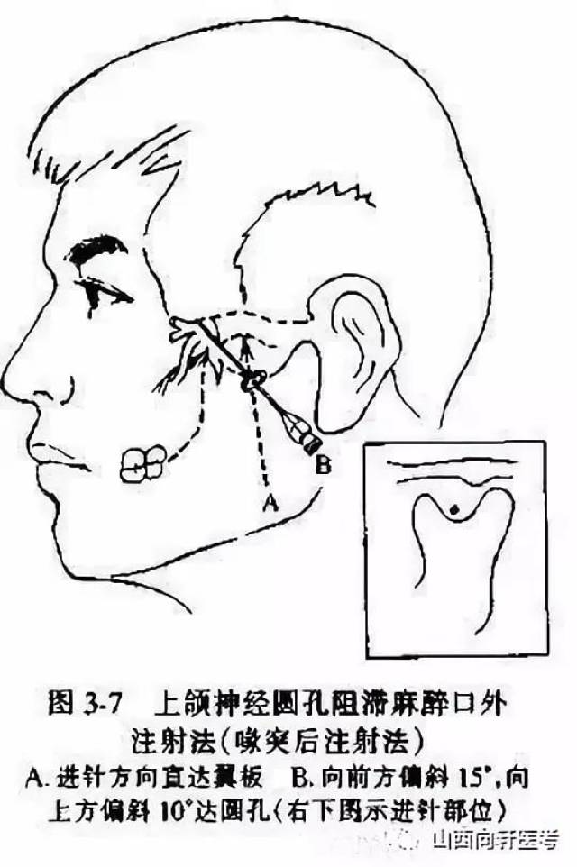 牙齿打麻药的位置图图片