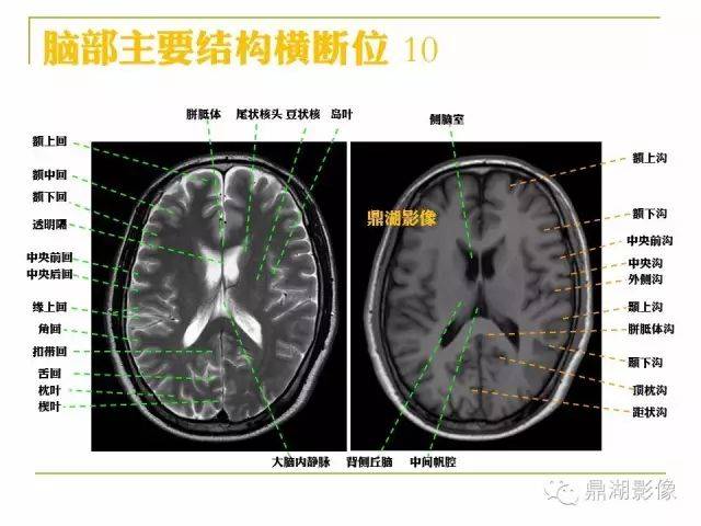 超详细头颅mr高清解剖(必点收藏)