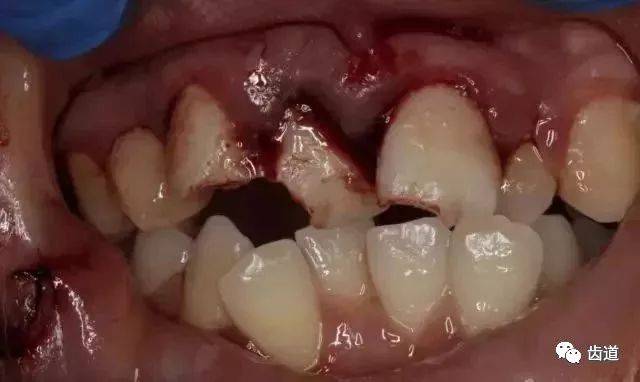 前牙外伤面前得心应手,应急处理临危不乱!