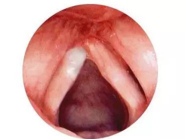嗓音疾病的种类很多,常见的包括急慢性喉炎,声带息肉,声带小结,功能性