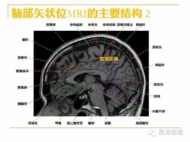 大脑矢状位解剖图图片