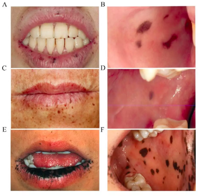 黑斑息肉嘴唇黑斑图片图片